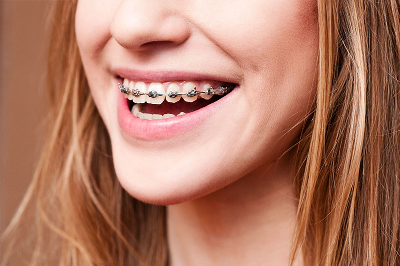 Orthodontics in Napa